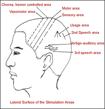Side-view scalp acupuncture diagram with labeled motor, sensory, speech, and other stimulation areas